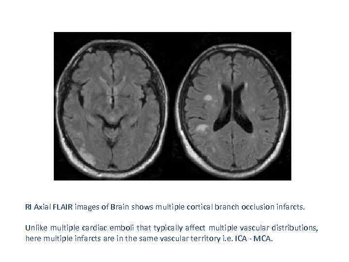 RI Axial FLAIR images of Brain shows multiple cortical branch occlusion infarcts. Unlike multiple