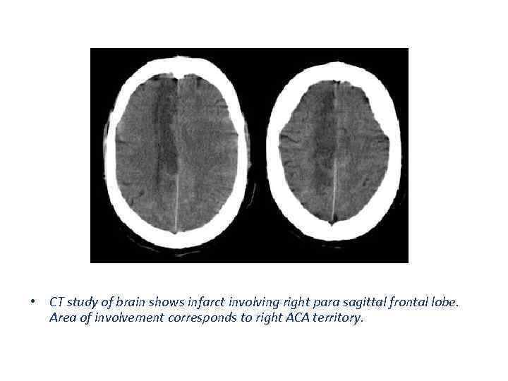  • CT study of brain shows infarct involving right para sagittal frontal lobe.