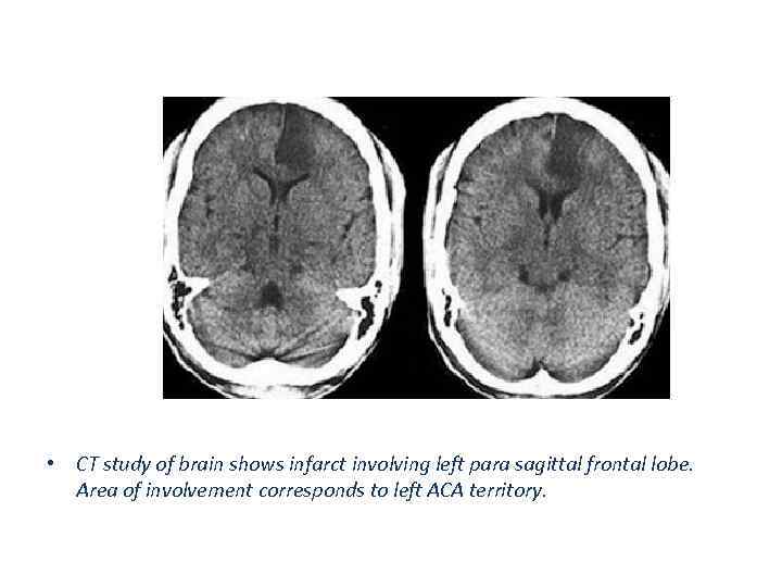  • CT study of brain shows infarct involving left para sagittal frontal lobe.
