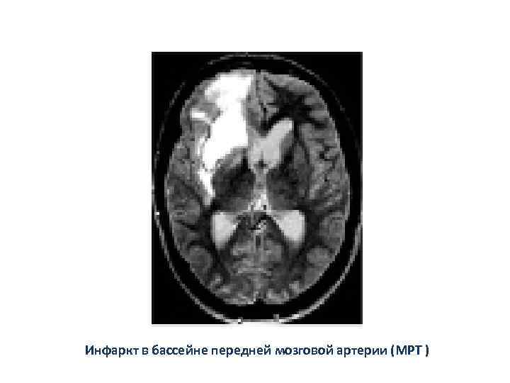 Инфаркт в бассейне передней мозговой артерии (МРТ ) 
