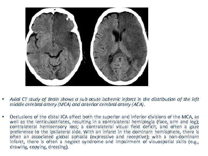  • Axial CT study of Brain shows a sub acute ischemic infarct in