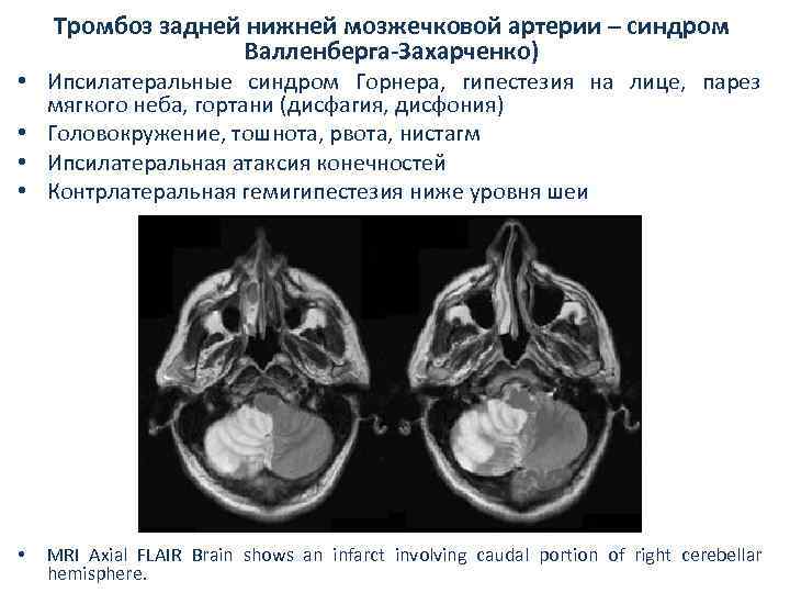 Тромбоз задней нижней мозжечковой артерии – синдром Валленберга-Захарченко) • Ипсилатеральные синдром Горнера, гипестезия на