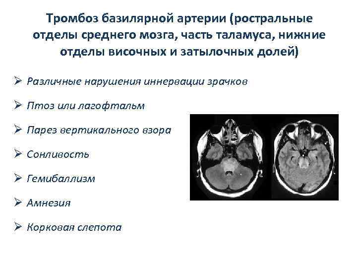 Тромбоз базилярной артерии (ростральные отделы среднего мозга, часть таламуса, нижние отделы височных и затылочных