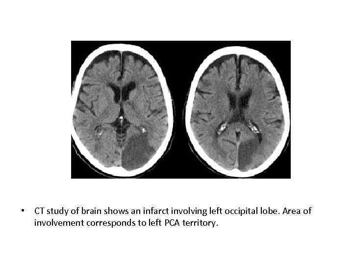  • CT study of brain shows an infarct involving left occipital lobe. Area