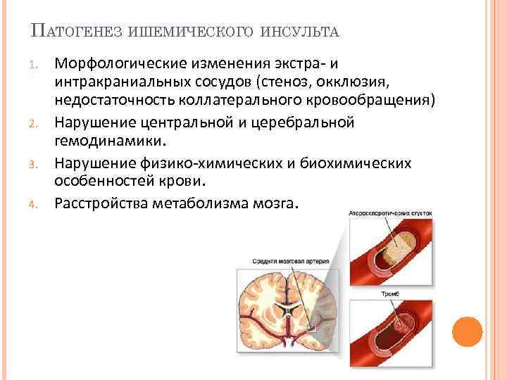 Атеросклероз интракраниального отдела