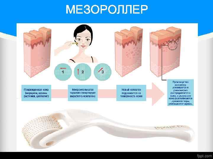 МЕЗОРОЛЛЕР 