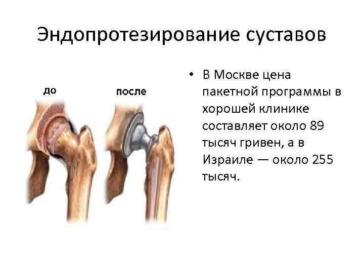Эндопротезирование суставов • В Москве цена пакетной программы в хорошей клинике составляет около 89