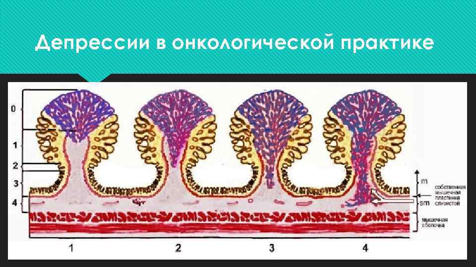 Депрессии в онкологической практике 