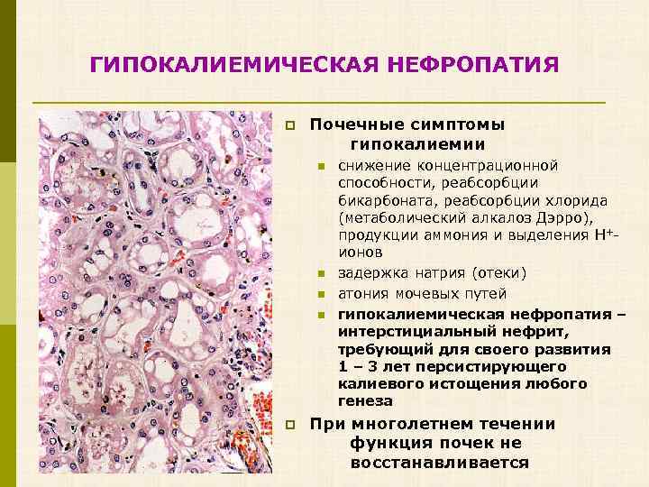 ГИПОКАЛИЕМИЧЕСКАЯ НЕФРОПАТИЯ p Почечные симптомы гипокалиемии n n p снижение концентрационной способности, реабсорбции бикарбоната,