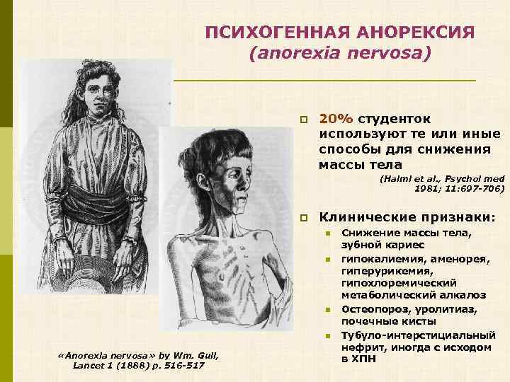 ПСИХОГЕННАЯ АНОРЕКСИЯ (anorexia nervosa) p 20% студенток используют те или иные способы для снижения