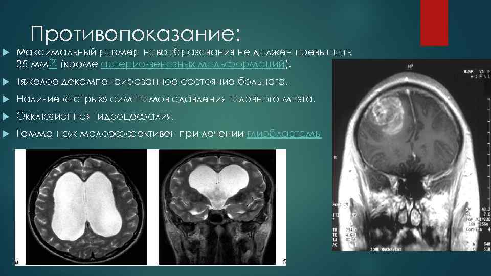 Противопоказание: Максимальный размер новообразования не должен превышать 35 мм[2] (кроме артерио-венозных мальформаций). Тяжелое декомпенсированное