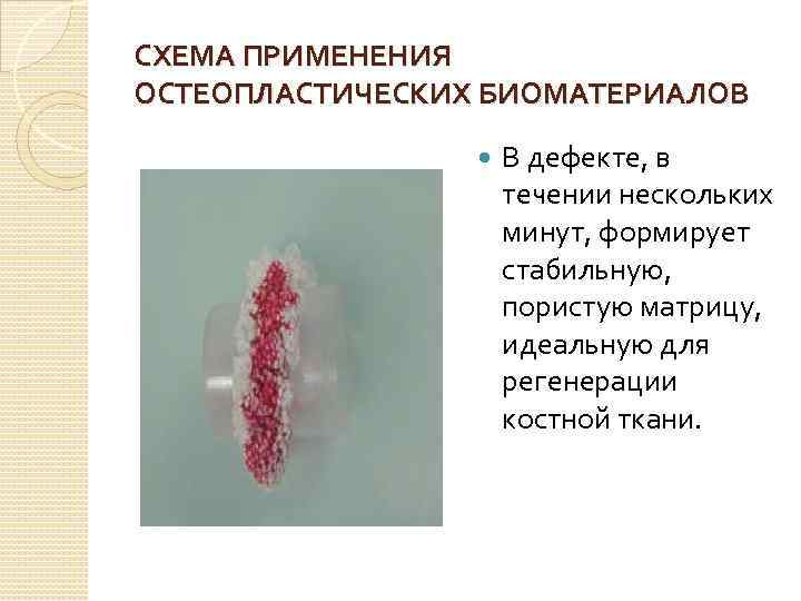 СХЕМА ПРИМЕНЕНИЯ ОСТЕОПЛАСТИЧЕСКИХ БИОМАТЕРИАЛОВ В дефекте, в течении нескольких минут, формирует стабильную, пористую матрицу,