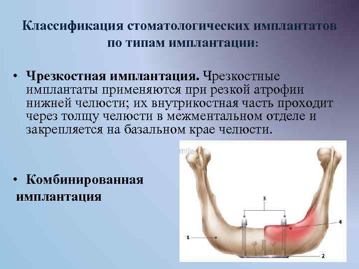 Классификация стоматологических имплантатов по типам имплантации: • Чрезкостная имплантация. Чрезкостные имплантаты применяются при резкой