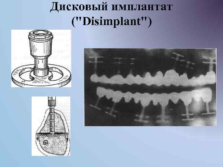 Дисковый имплантат ("Disimplant") 