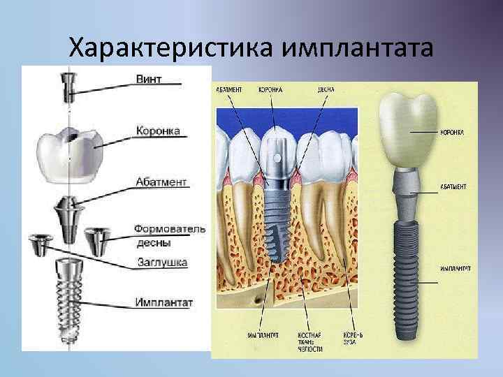 Характеристика имплантата 