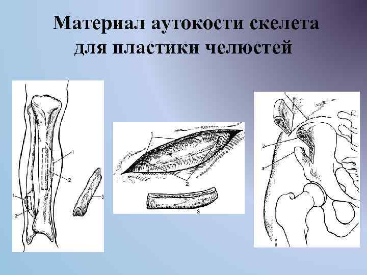 Материал аутокости скелета для пластики челюстей 