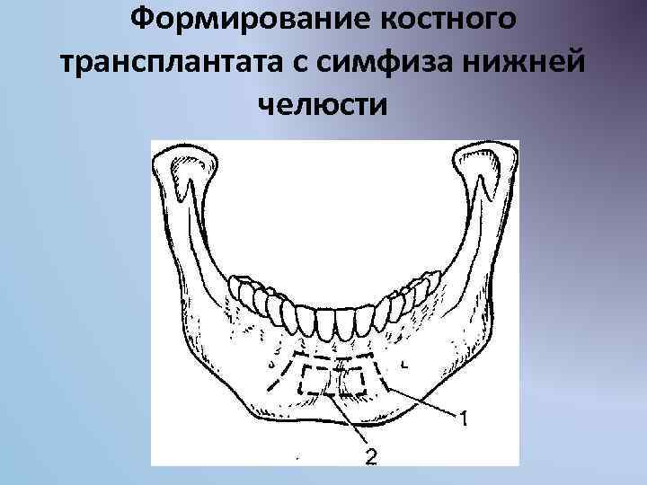 Формирование костного трансплантата с симфиза нижней челюсти 