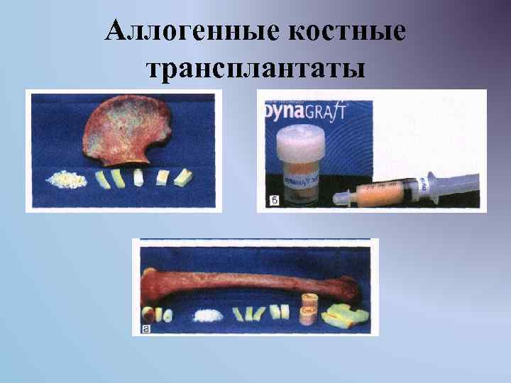 Аллогенные костные трансплантаты 