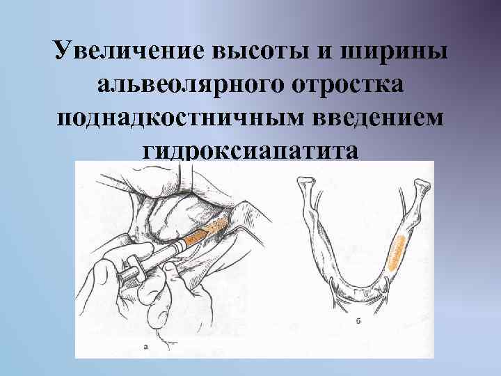 Увеличение высоты и ширины альвеолярного отростка поднадкостничным введением гидроксиапатита 