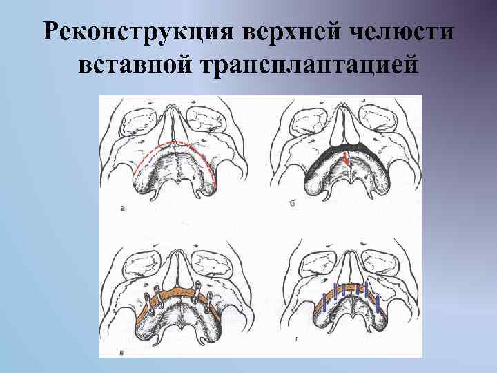 Реконструкция верхней челюсти вставной трансплантацией 