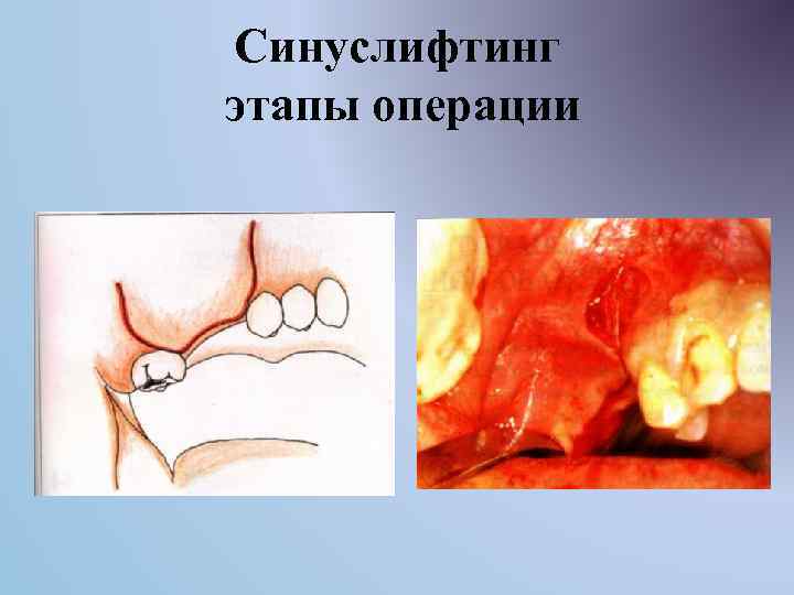 Синуслифтинг этапы операции 