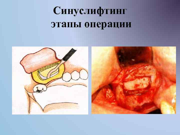 Синуслифтинг этапы операции 