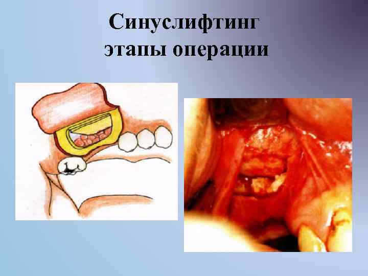 Синуслифтинг этапы операции 