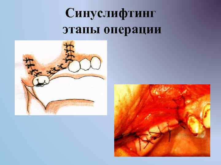 Синуслифтинг этапы операции 