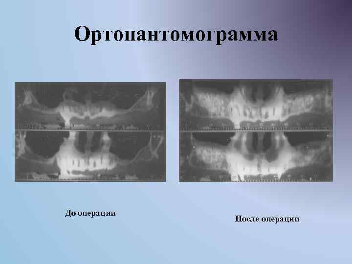 Ортопантомограмма До операции После операции 