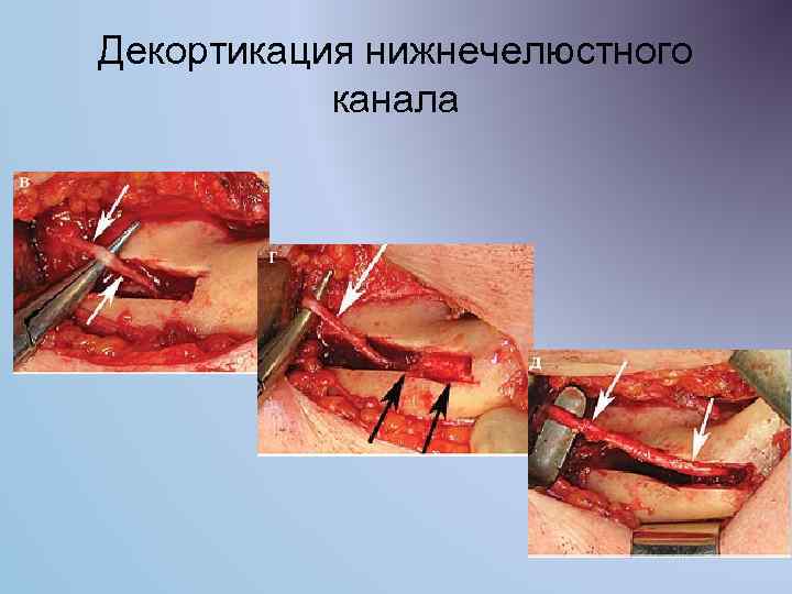 Декортикация нижнечелюстного канала 