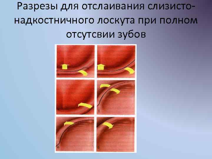 Разрезы для отслаивания слизистонадкостничного лоскута при полном отсутсвии зубов 