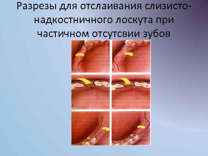 Разрезы для отслаивания слизистонадкостничного лоскута при частичном отсутсвии зубов 