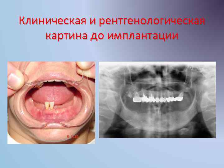 Клиническая и рентгенологическая картина до имплантации 