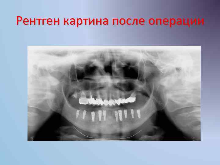 Рентген картина после операции 