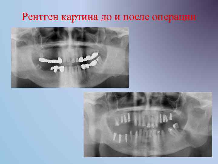 Рентген картина до и после операции 