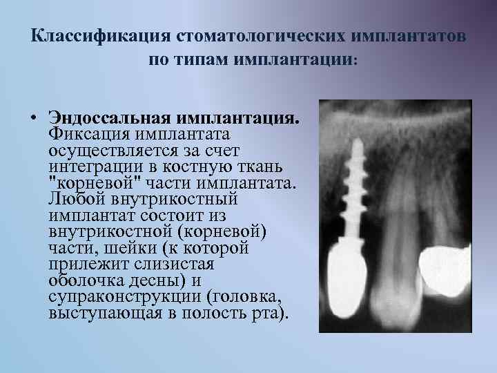 Классификация стоматологических имплантатов по типам имплантации: • Эндоссальная имплантация. Фиксация имплантата осуществляется за счет