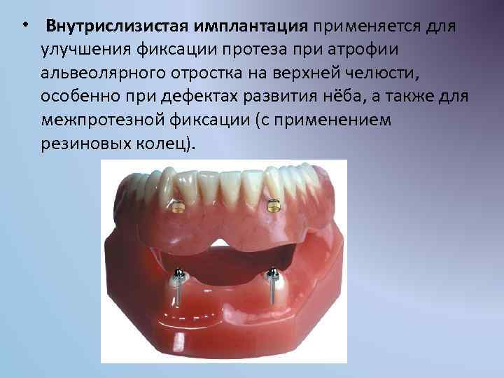  • Внутрислизистая имплантация применяется для улучшения фиксации протеза при атрофии альвеолярного отростка на