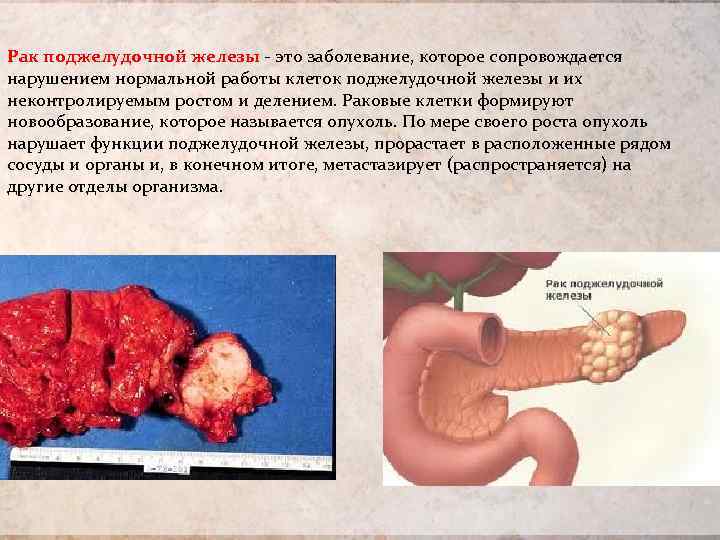 Рак поджелудочной железы это заболевание, которое сопровождается нарушением нормальной работы клеток поджелудочной железы и