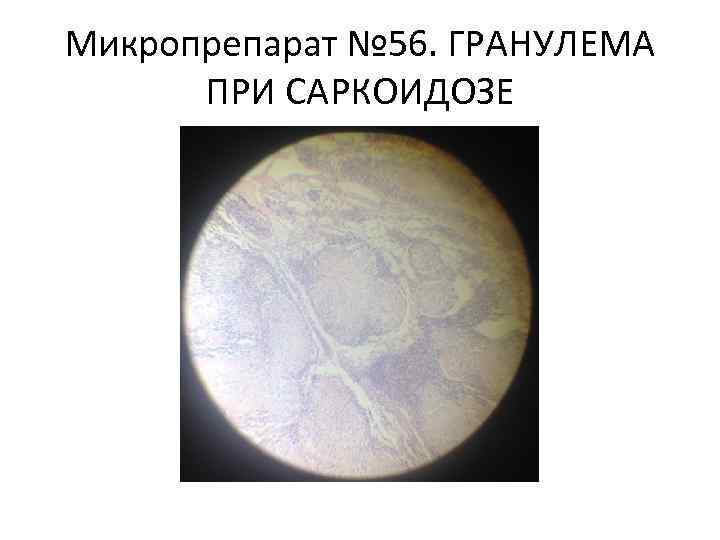 Микропрепарат № 56. ГРАНУЛЕМА ПРИ САРКОИДОЗЕ 