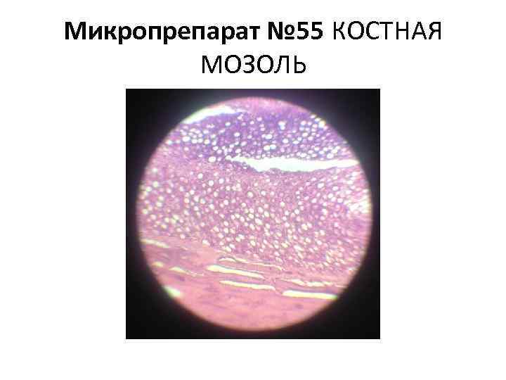 Микропрепарат № 55 КОСТНАЯ МОЗОЛЬ 