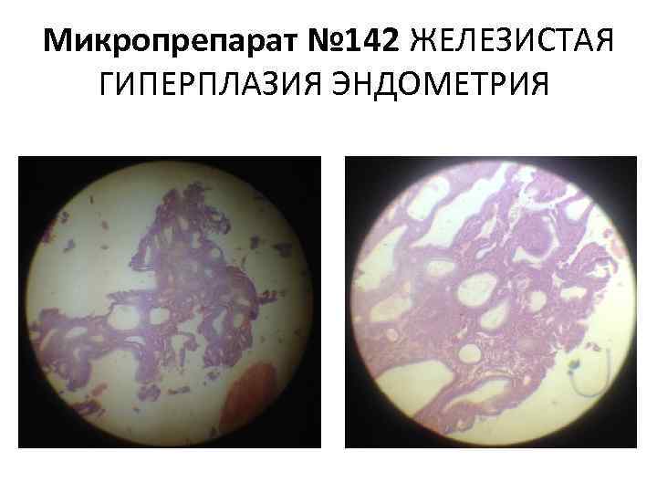 17 опк при гиперплазии эндометрия схема приема