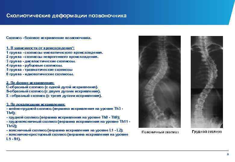 Сколиотические деформации позвоночника Сколиоз боковое искривление позвоночника. 1. В зависимости от происхождения*: 1 группа
