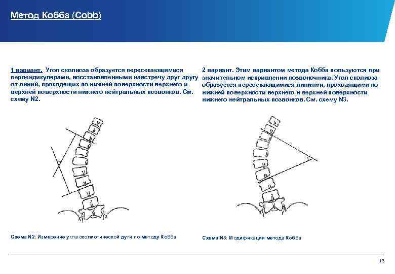 Метод Кобба (Cobb) 1 вариант. Угол сколиоза образуется пересекающимися перпендикулярами, восстановленными навстречу другу от