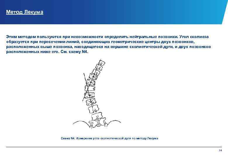 Метод Лекума Этим методом пользуются при невозможности определить нейтральные позвонки. Угол сколиоза образуется при