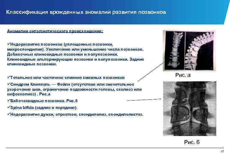 Классификация врожденных аномалий развития позвонков Аномалии онтогенетического происхождения: üНедоразвитие позвонков (уплощенные позвонки, микроспондилия). Увеличение