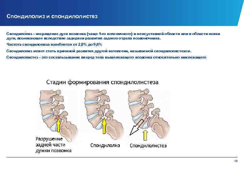 Спондилолиз и спондилолистез Спондило лиз несращение дуги позвонка (чаще 5 го поясничного) в межсуставной