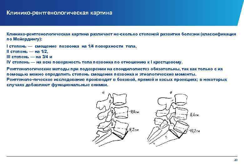 Клинико рентгенологическая картина различает не сколько степеней развития болезни (классификация по Мейердингу): I степень