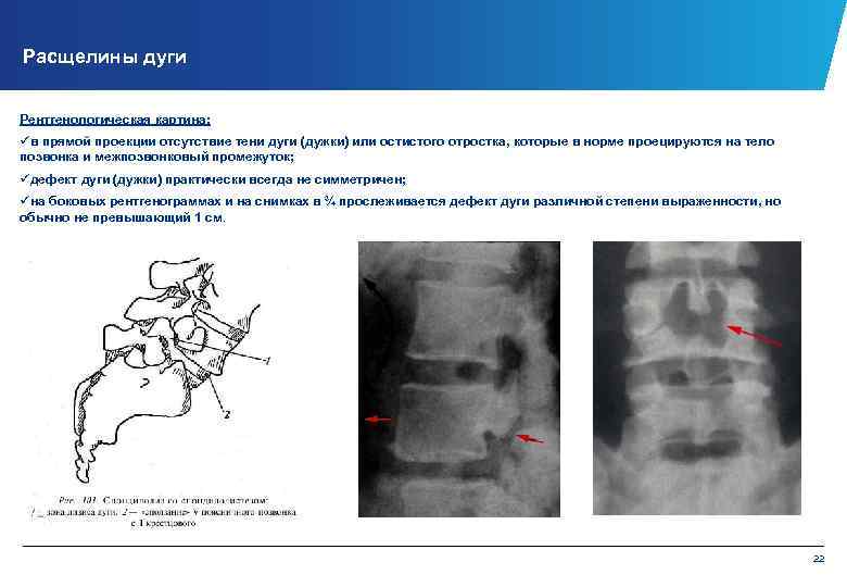 Расщелины дуги Рентгенологическая картина: üв прямой проекции отсутствие тени дуги (дужки) или остистого отростка,