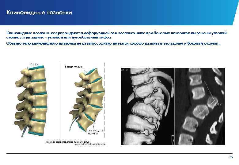 Клиновидные позвонки сопровождаются деформацией оси позвоночника: при боковых позвонках выражены угловой сколиоз, при задних