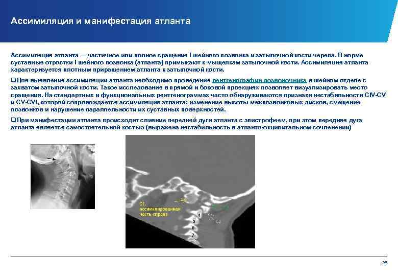 Ассимиляция и манифестация атланта Ассимиляция атланта — частичное или полное сращение I шейного позвонка